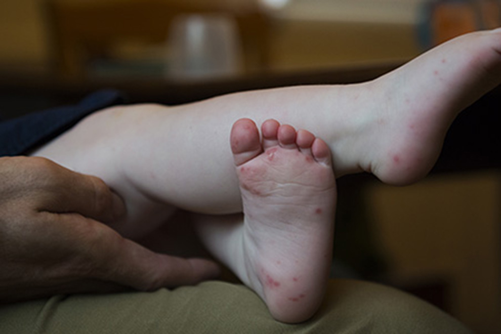 baby foot with hand, foot, and mouth disease