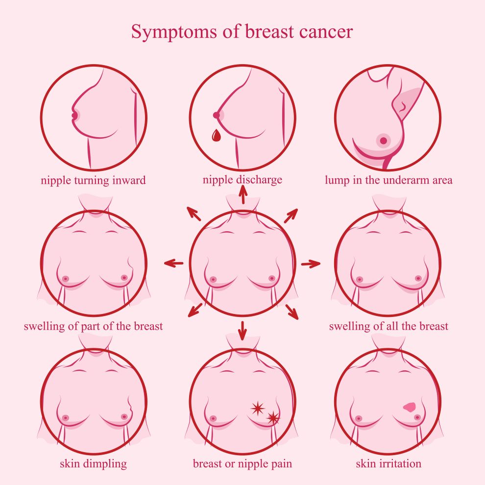Symptoms of breast cancer with images
