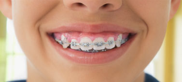 child-braces_377x171